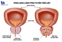 Phì đại tuyến tiền liệt: Nguyên nhân - Triệu chứng -phòng ngừa