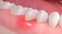  Làm thế nào để điều trị và ngăn ngừa hơi thở nặng mùi ?