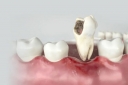 Các cách trị viêm chân răng tại nhà